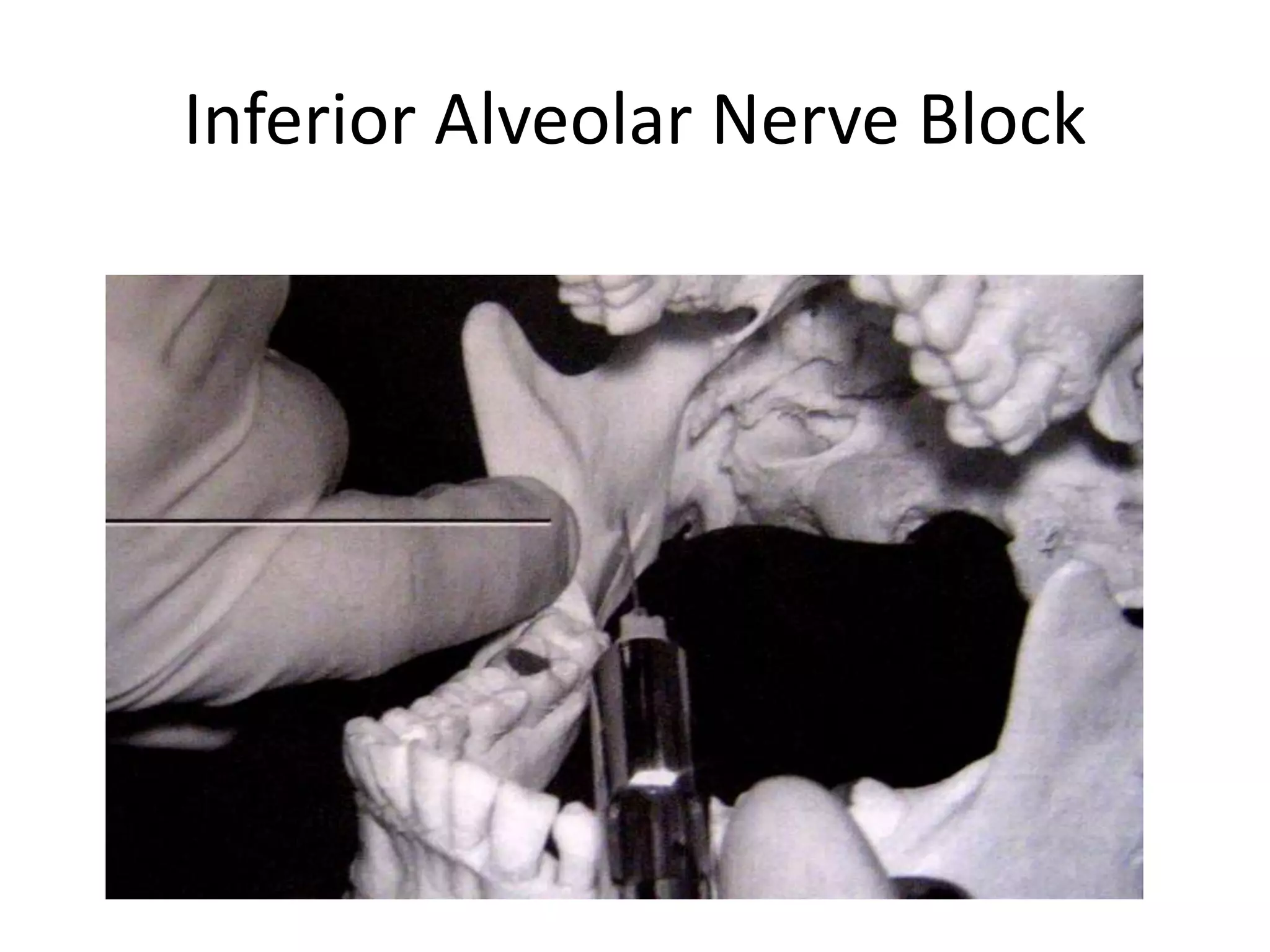 Inferior Alveolar Nerve Block
 