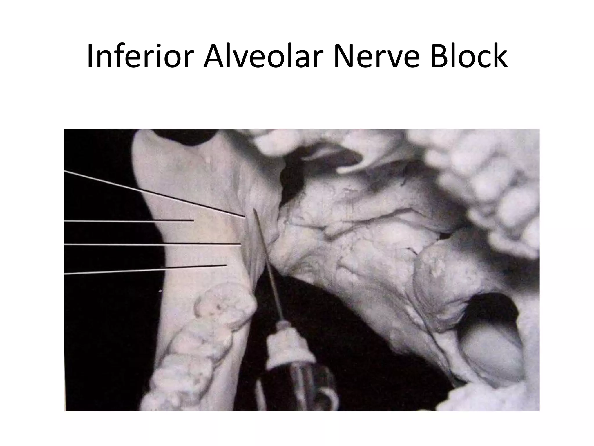 Inferior Alveolar Nerve Block
 