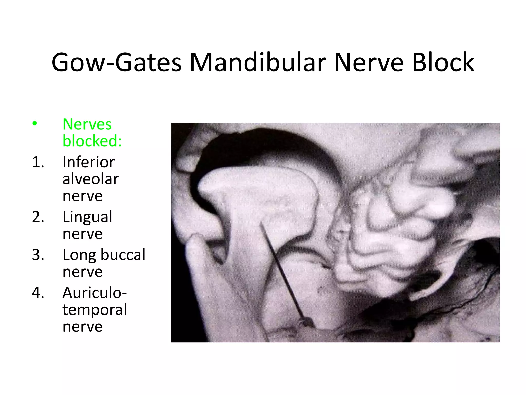 Gow-Gates Mandibular Nerve Block
• Nerves
blocked:
1. Inferior
alveolar
nerve
2. Lingual
nerve
3. Long buccal
nerve
4. Auriculo-
temporal
nerve
 