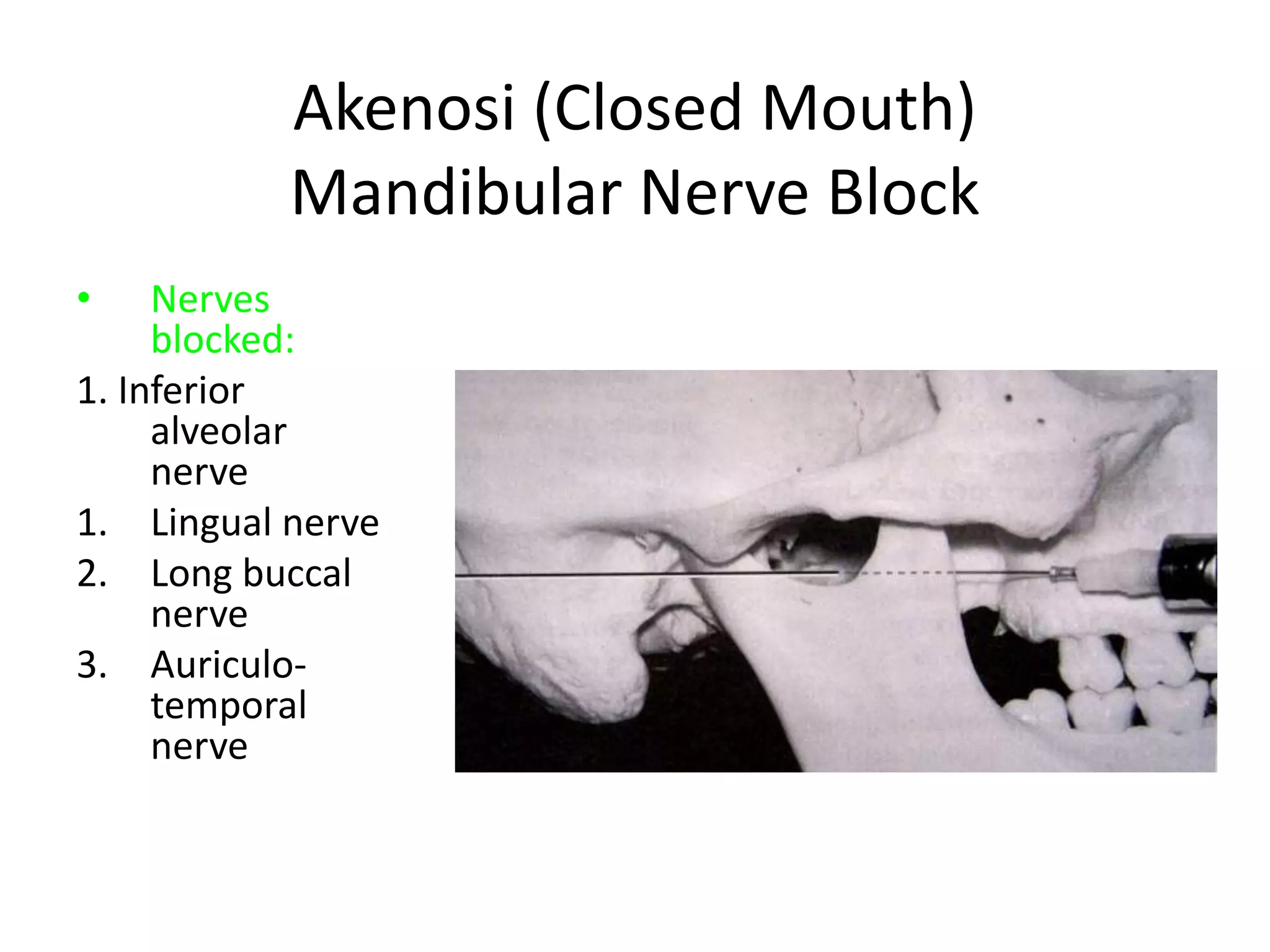 Akenosi (Closed Mouth)
Mandibular Nerve Block
• Nerves
blocked:
1. Inferior
alveolar
nerve
1. Lingual nerve
2. Long buccal
nerve
3. Auriculo-
temporal
nerve
 