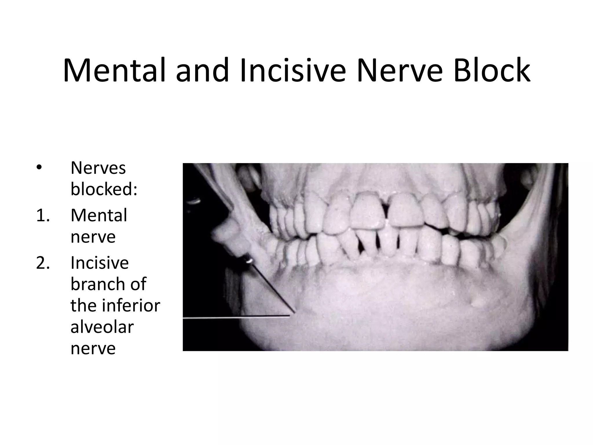 Mental and Incisive Nerve Block
• Nerves
blocked:
1. Mental
nerve
2. Incisive
branch of
the inferior
alveolar
nerve
 