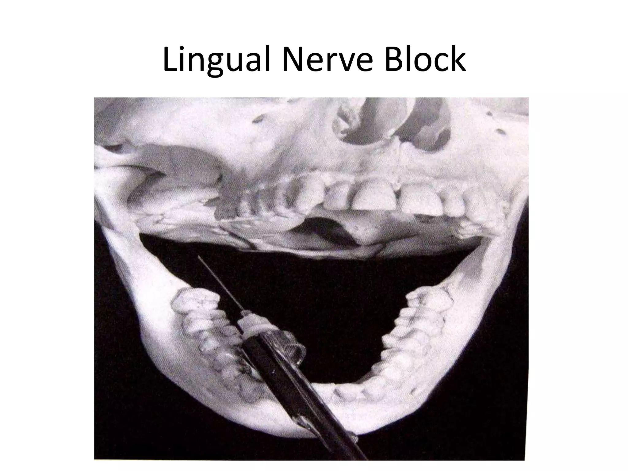 Lingual Nerve Block
 