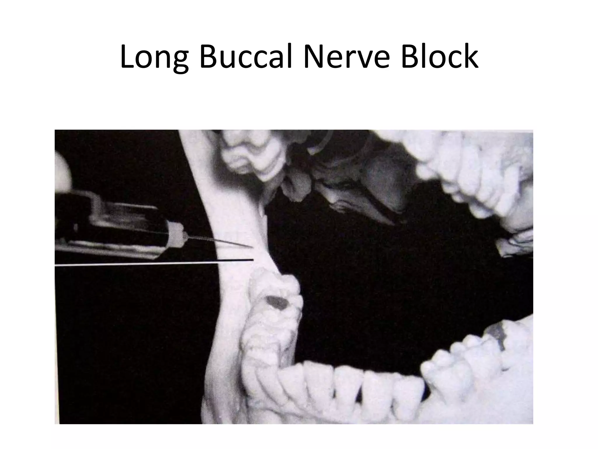 Long Buccal Nerve Block
 