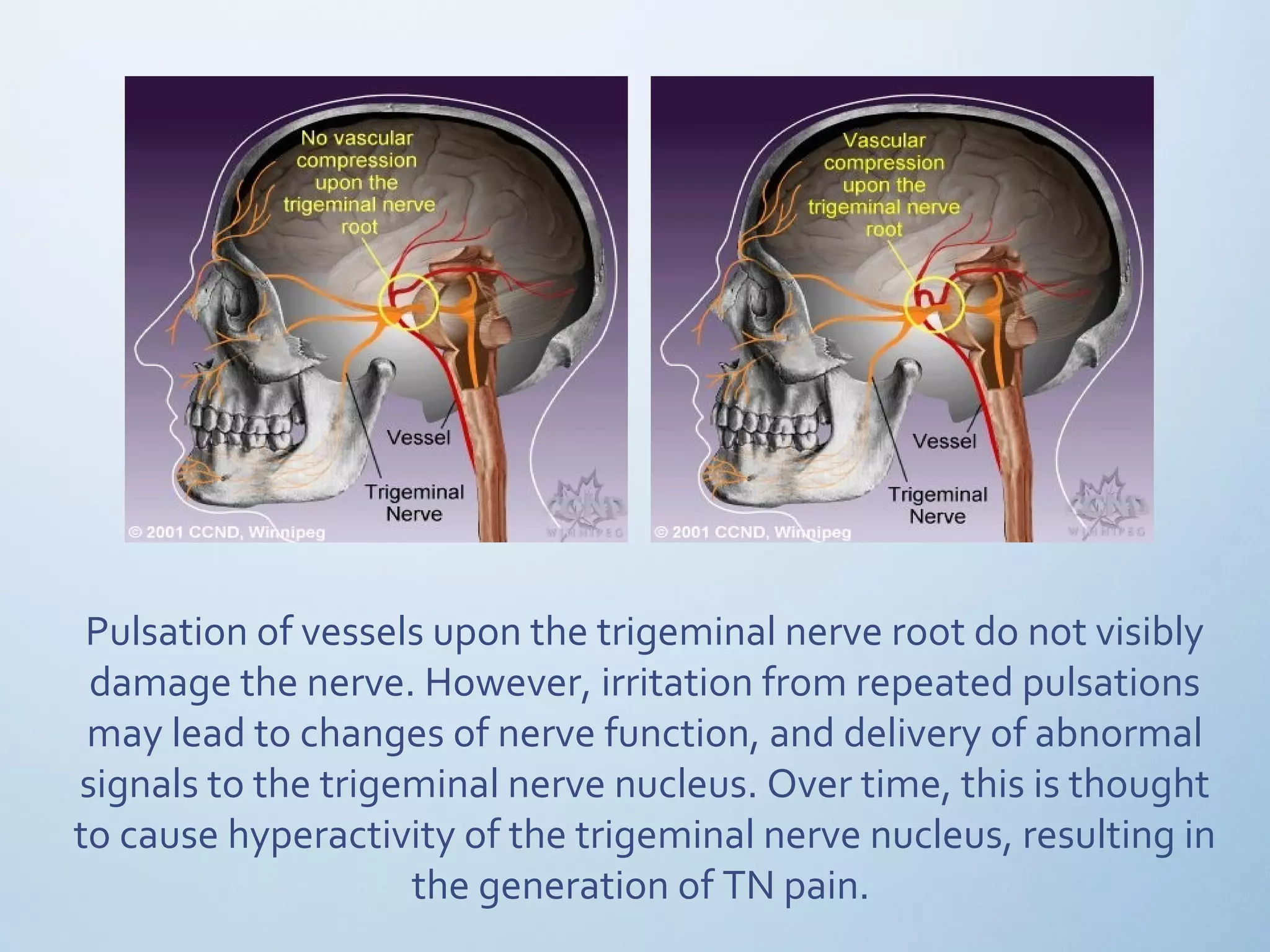 Pulsation of vessels upon the trigeminal nerve root do not visibly
damage the nerve. However, irritation from repeated pulsations
may lead to changes of nerve function, and delivery of abnormal
signals to the trigeminal nerve nucleus. Over time, this is thought
to cause hyperactivity of the trigeminal nerve nucleus, resulting in
the generation of TN pain.
 