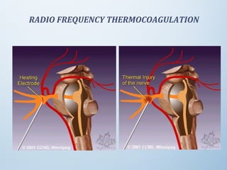 RADIO FREQUENCY THERMOCOAGULATION
 