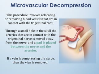 Microvascular Decompression
This procedure involves relocating
or removing blood vessels that are in
contact with the trigeminal root.
Through a small hole in the skull the
arteries that are in contact with the
trigeminal nerve is moved away
from the nerve, and a pad is placed
between the nerve and the
arteries.
If a vein is compressing the nerve,
then the vien is removed.
 
