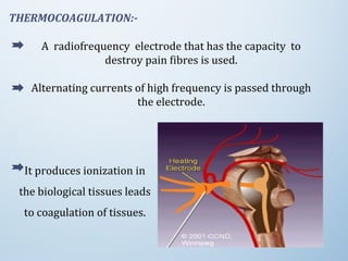 THERMOCOAGULATION:-
A radiofrequency electrode that has the capacity to
destroy pain fibres is used.
Alternating currents of high frequency is passed through
the electrode.
It produces ionization in
the biological tissues leads
to coagulation of tissues.
 
