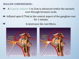 BALLON COMPRESSION:-
A Fogarty catheter 1 to 2cm is advanced within the meckels
cave through foramen ovale.
.
Inflated upto 0.75ml at the ventral aspect of the ganglion root
for 1 minute.
.
It destroyes the root fibres.
 