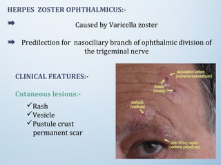 HERPES ZOSTER OPHTHALMICUS:-
Caused by Varicella zoster
Predilection for nasociliary branch of ophthalmic division of
the trigeminal nerve
CLINICAL FEATURES:-
Cutaneous lesions:-
Rash
Vesicle
Pustule crust
permanent scar
 