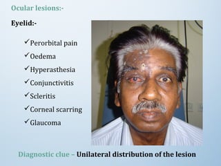 Ocular lesions:-
Eyelid:-
Perorbital pain
Oedema
Hyperasthesia
Conjunctivitis
Scleritis
Corneal scarring
Glaucoma
Diagnostic clue – Unilateral distribution of the lesion
 