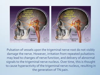 Pulsation of vessels upon the trigeminal nerve root do not visibly
damage the nerve. However, irritation from repeated pulsations
may lead to changes of nerve function, and delivery of abnormal
signals to the trigeminal nerve nucleus. Over time, this is thought
to cause hyperactivity of the trigeminal nerve nucleus, resulting in
the generation of TN pain.
 