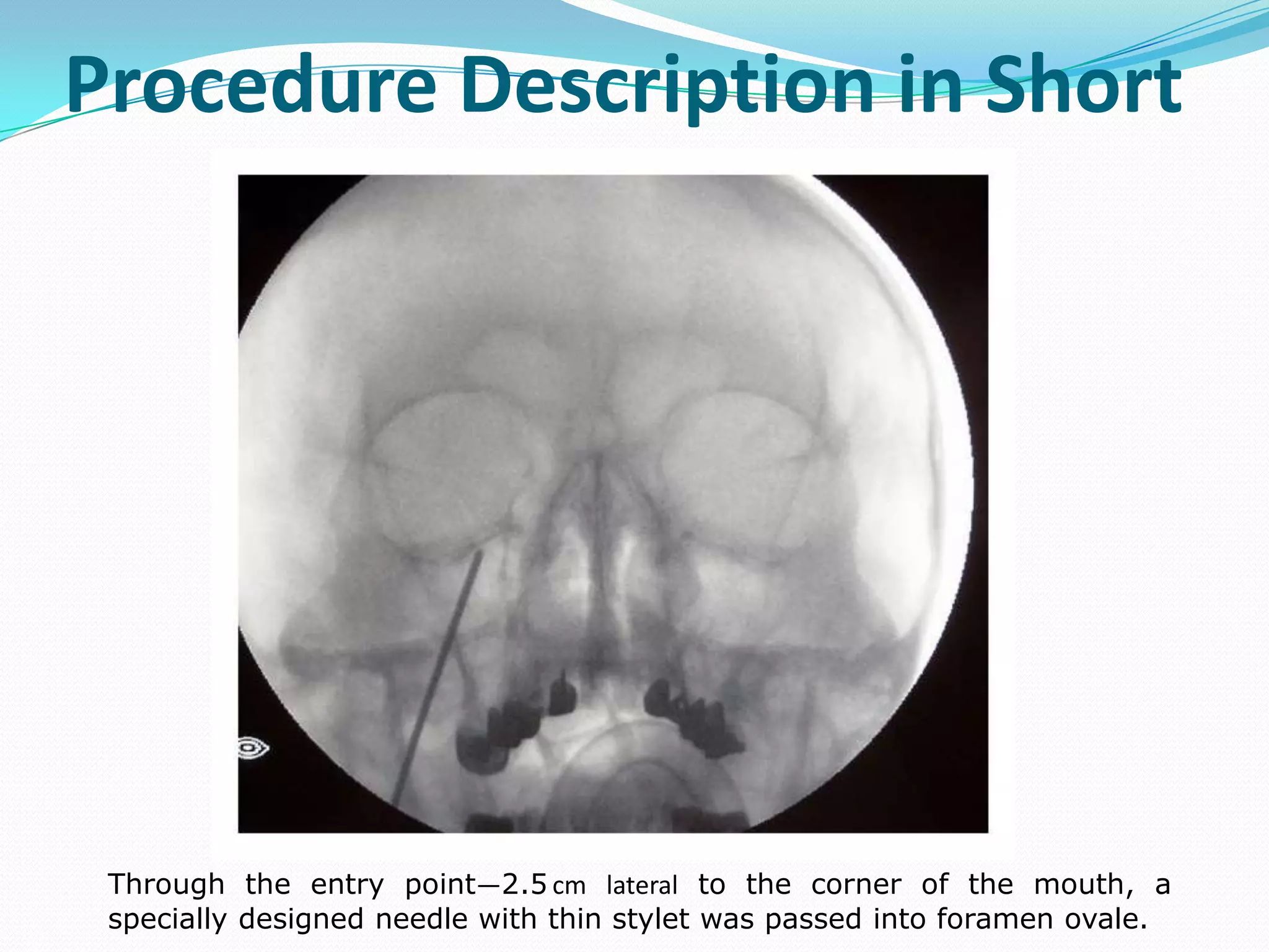 Procedure Description in Short
Through the entry point—2.5 cm lateral to the corner of the mouth, a
specially designed needle with thin stylet was passed into foramen ovale.
 