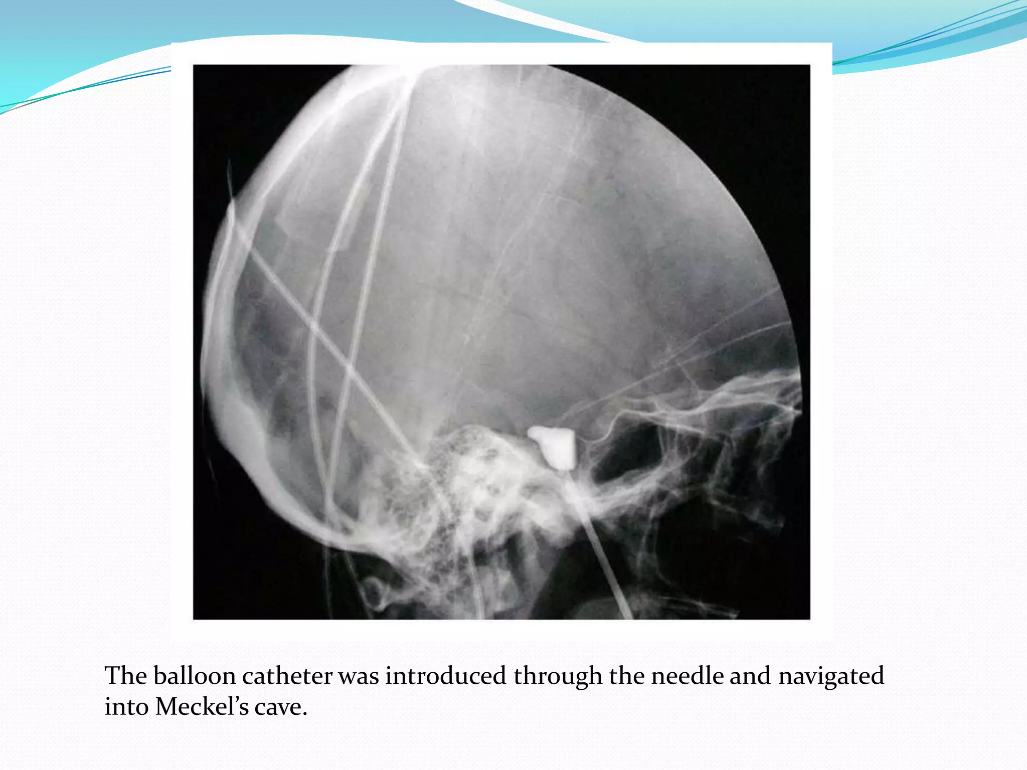 The balloon catheter was introduced through the needle and navigated
into Meckel’s cave.
 
