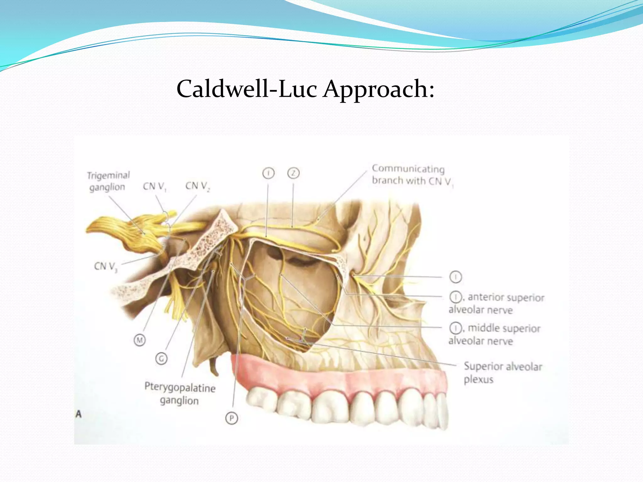 Caldwell-Luc Approach:
 