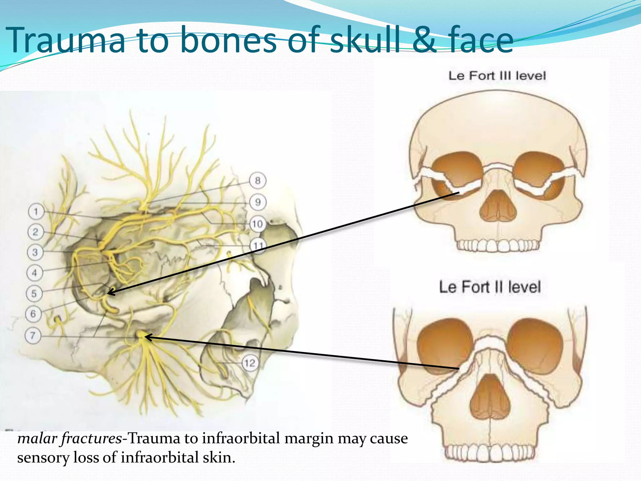 Trauma to bones of skull & face
malar fractures-Trauma to infraorbital margin may cause
sensory loss of infraorbital skin.
 