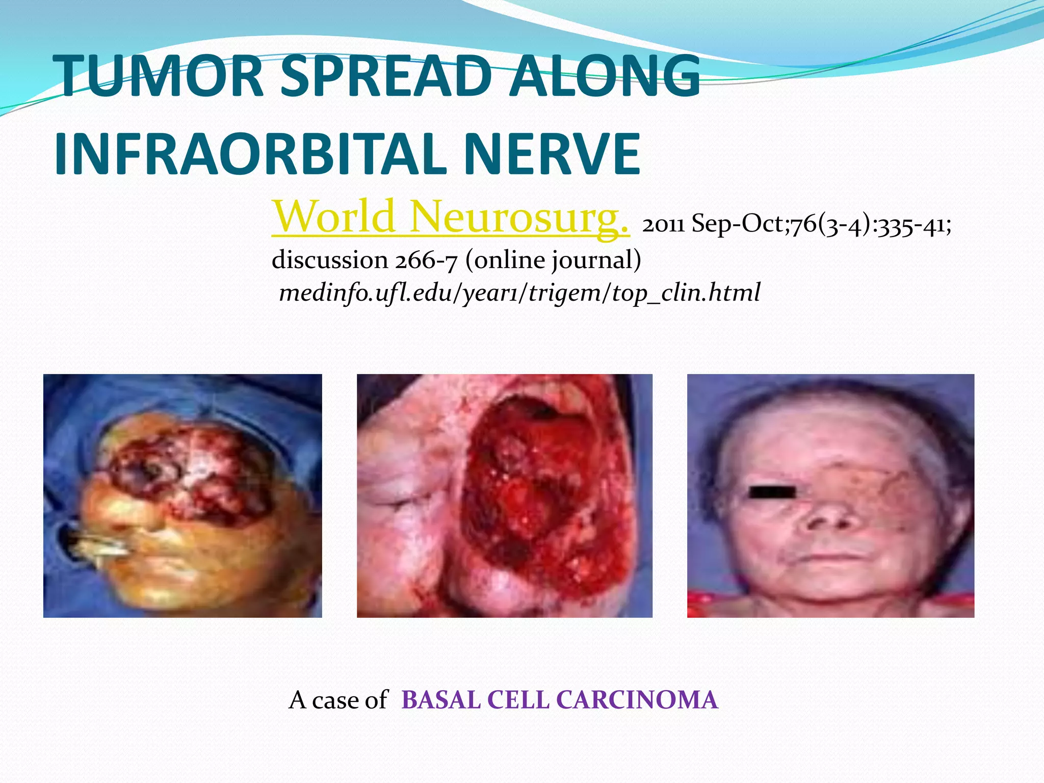 TUMOR SPREAD ALONG
INFRAORBITAL NERVE
World Neurosurg. 2011 Sep-Oct;76(3-4):335-41;
discussion 266-7 (online journal)
medinfo.ufl.edu/year1/trigem/top_clin.html
A case of BASAL CELL CARCINOMA
 