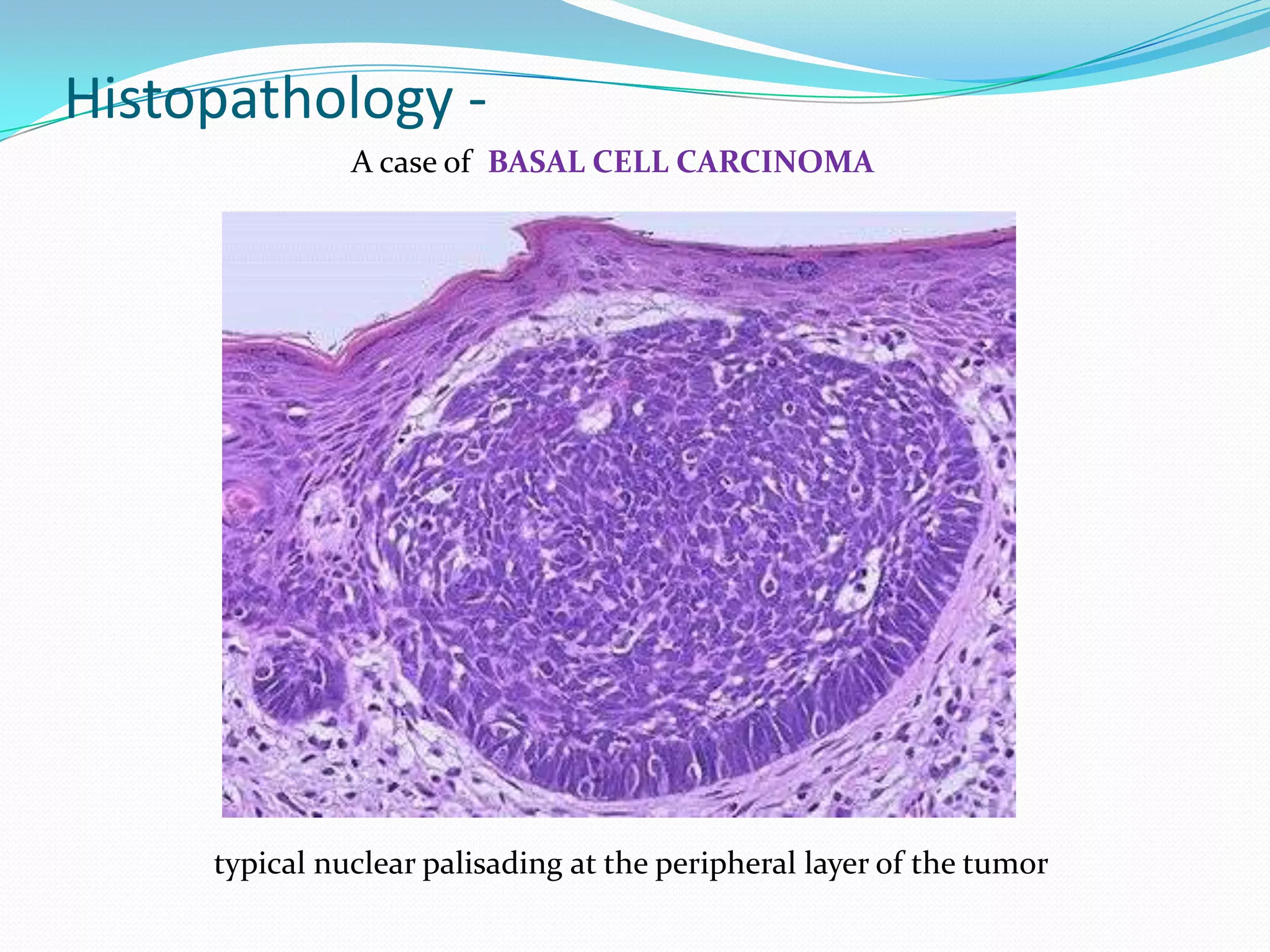Histopathology -
A case of BASAL CELL CARCINOMA
typical nuclear palisading at the peripheral layer of the tumor
 