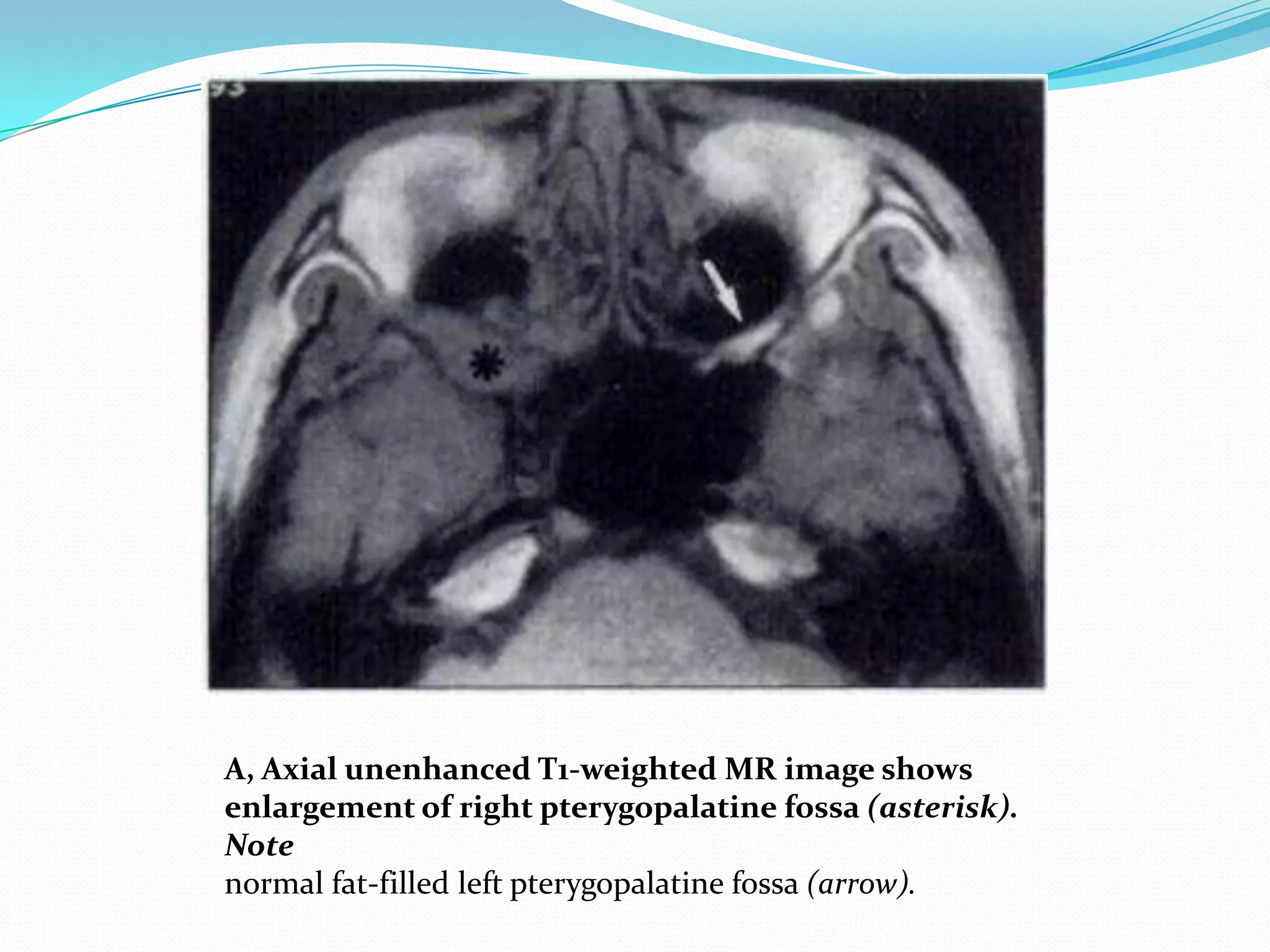 A, Axial unenhanced T1-weighted MR image shows
enlargement of right pterygopalatine fossa (asterisk).
Note
normal fat-filled left pterygopalatine fossa (arrow).
 