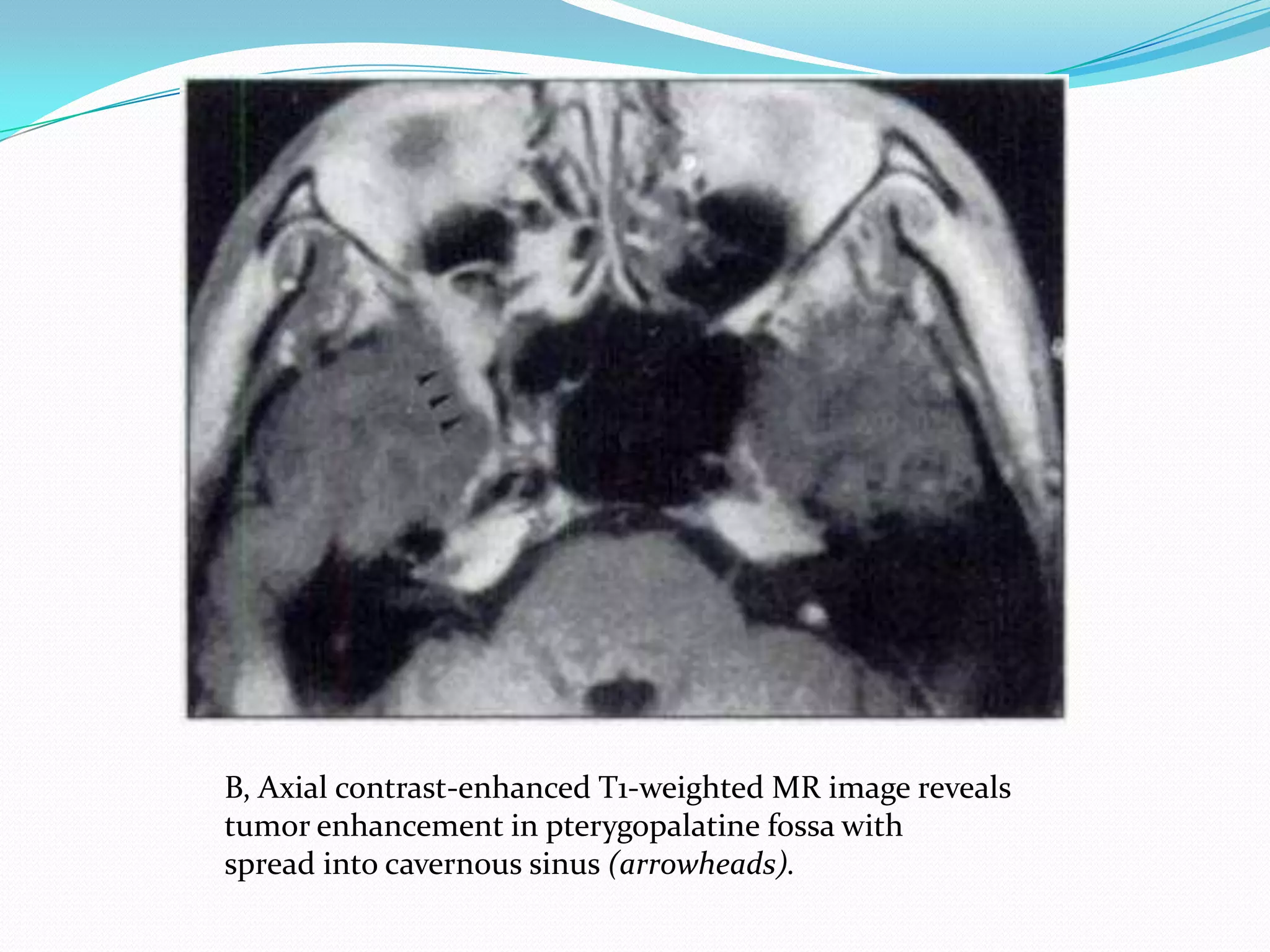 B, Axial contrast-enhanced T1-weighted MR image reveals
tumor enhancement in pterygopalatine fossa with
spread into cavernous sinus (arrowheads).
 