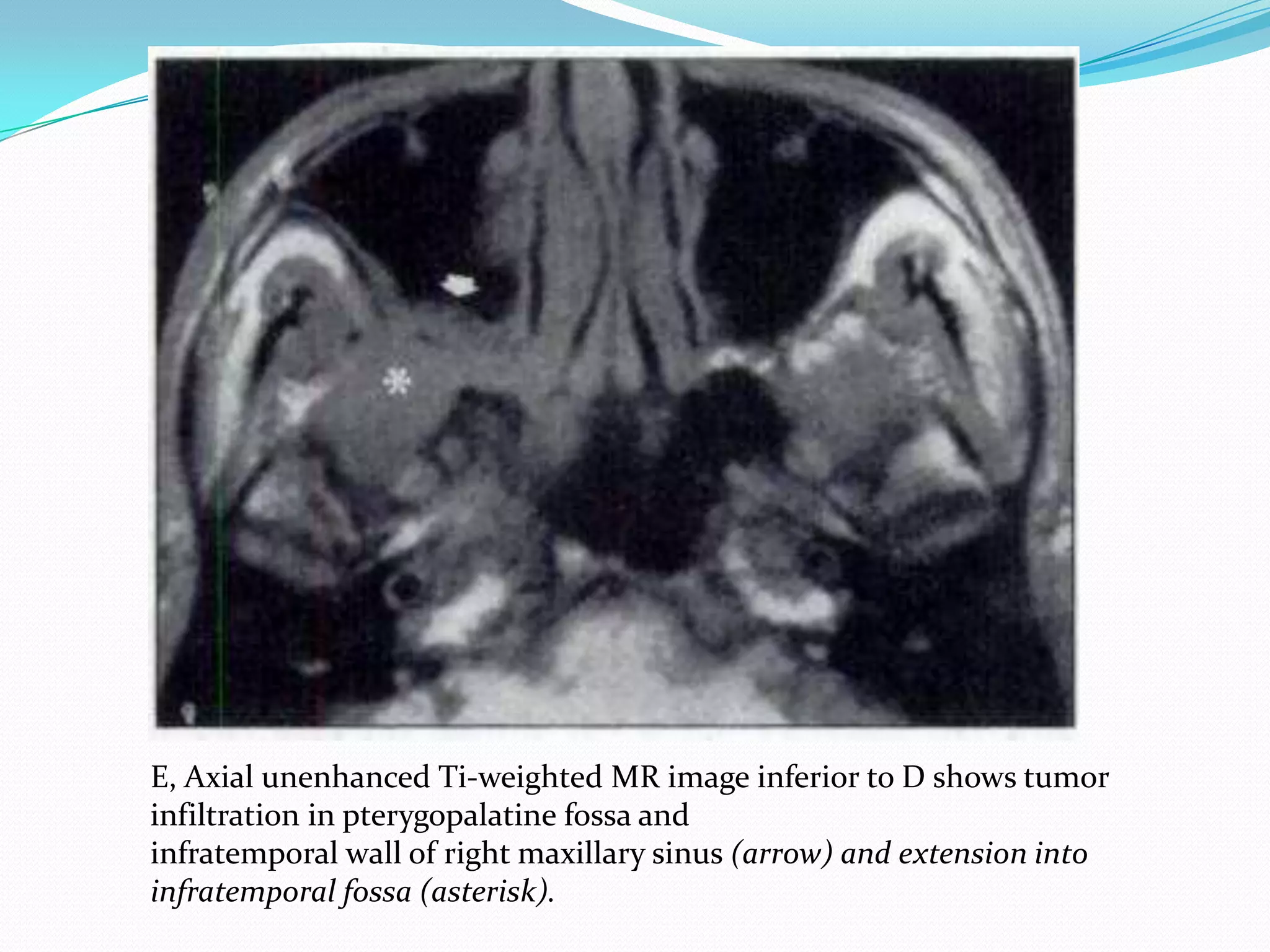 E, Axial unenhanced Ti-weighted MR image inferior to D shows tumor
infiltration in pterygopalatine fossa and
infratemporal wall of right maxillary sinus (arrow) and extension into
infratemporal fossa (asterisk).
 
