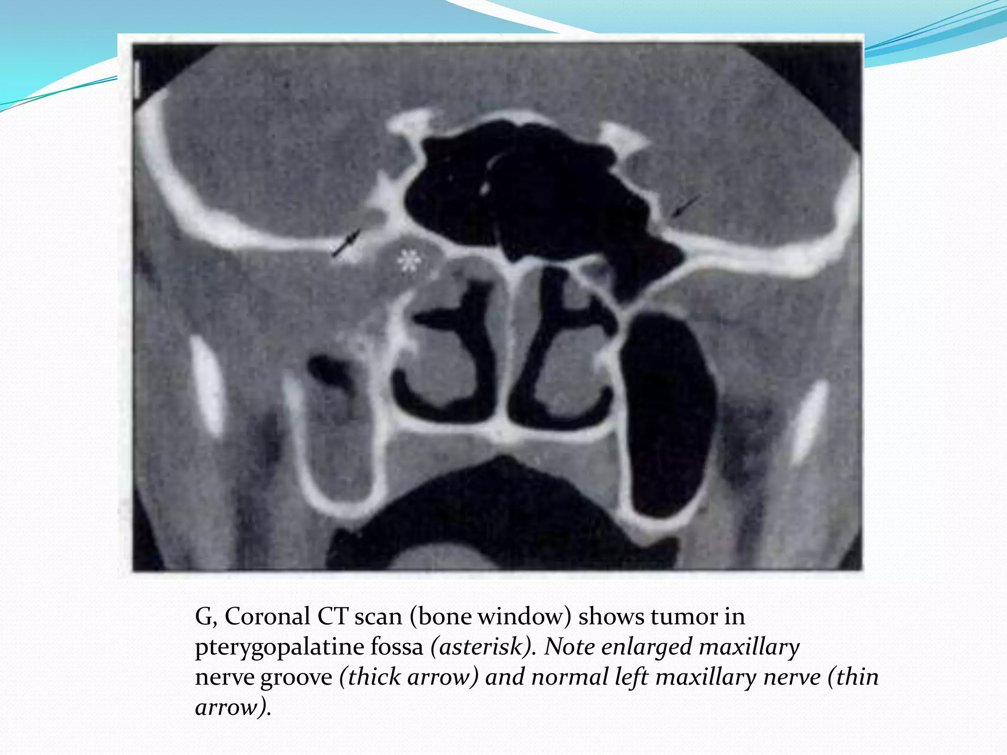 G, Coronal CT scan (bone window) shows tumor in
pterygopalatine fossa (asterisk). Note enlarged maxillary
nerve groove (thick arrow) and normal left maxillary nerve (thin
arrow).
 