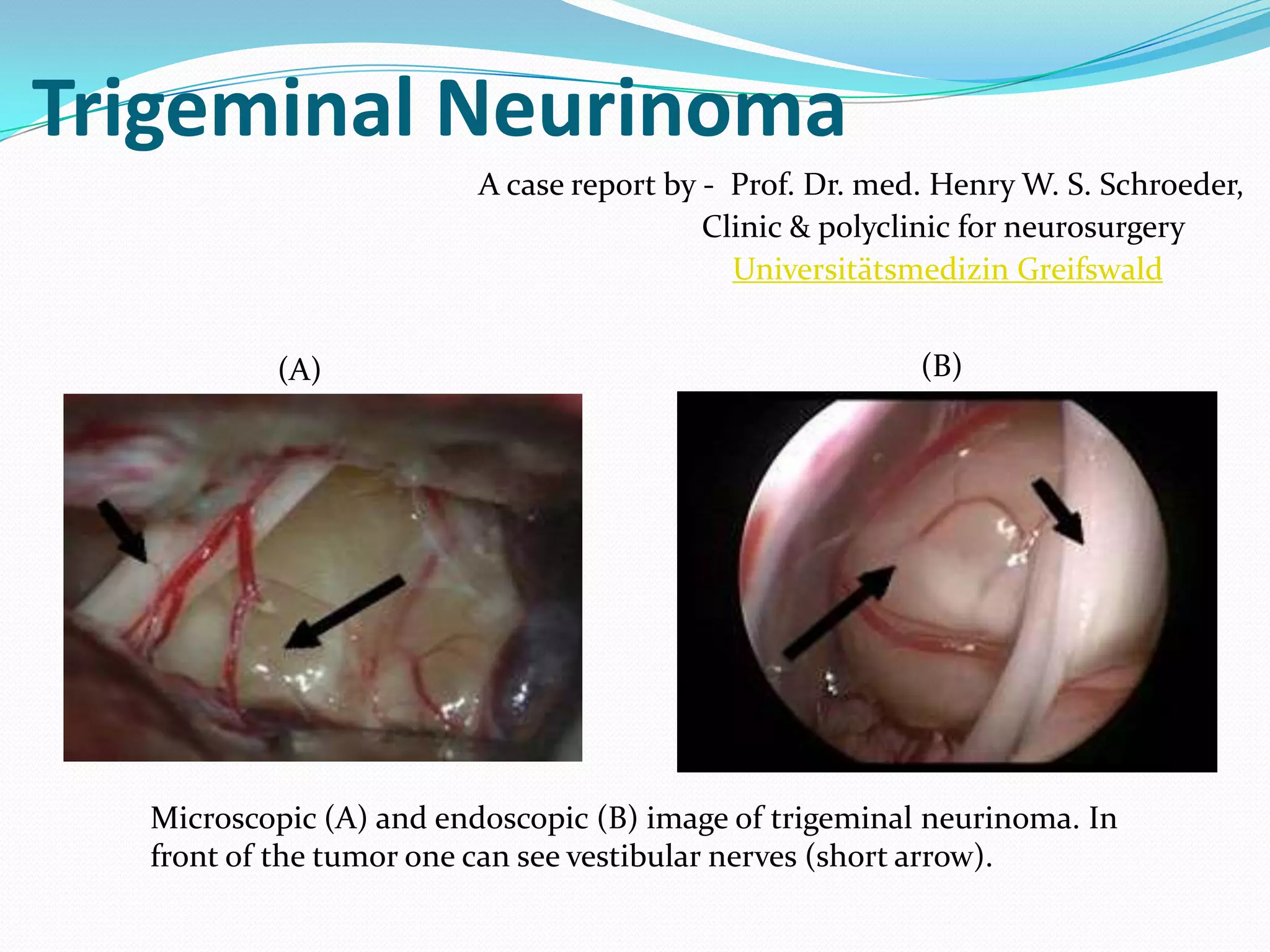 Trigeminal Neurinoma
Prof. Dr. med. Henry W. S. Schroeder,
Universitätsmedizin Greifswald
A case report by -
Clinic & polyclinic for neurosurgery
Microscopic (A) and endoscopic (B) image of trigeminal neurinoma. In
front of the tumor one can see vestibular nerves (short arrow).
(A) (B)
 