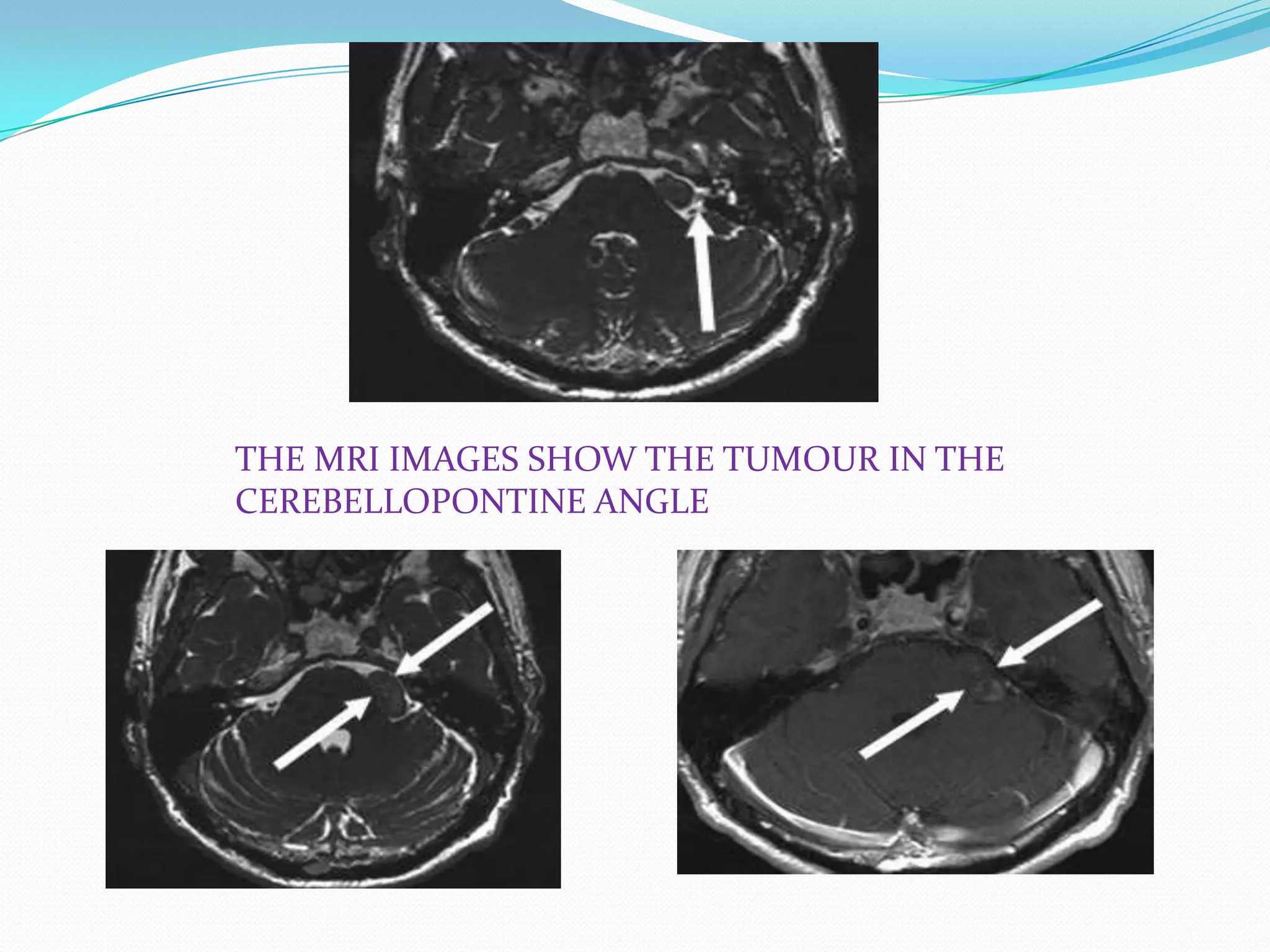 THE MRI IMAGES SHOW THE TUMOUR IN THE
CEREBELLOPONTINE ANGLE
 