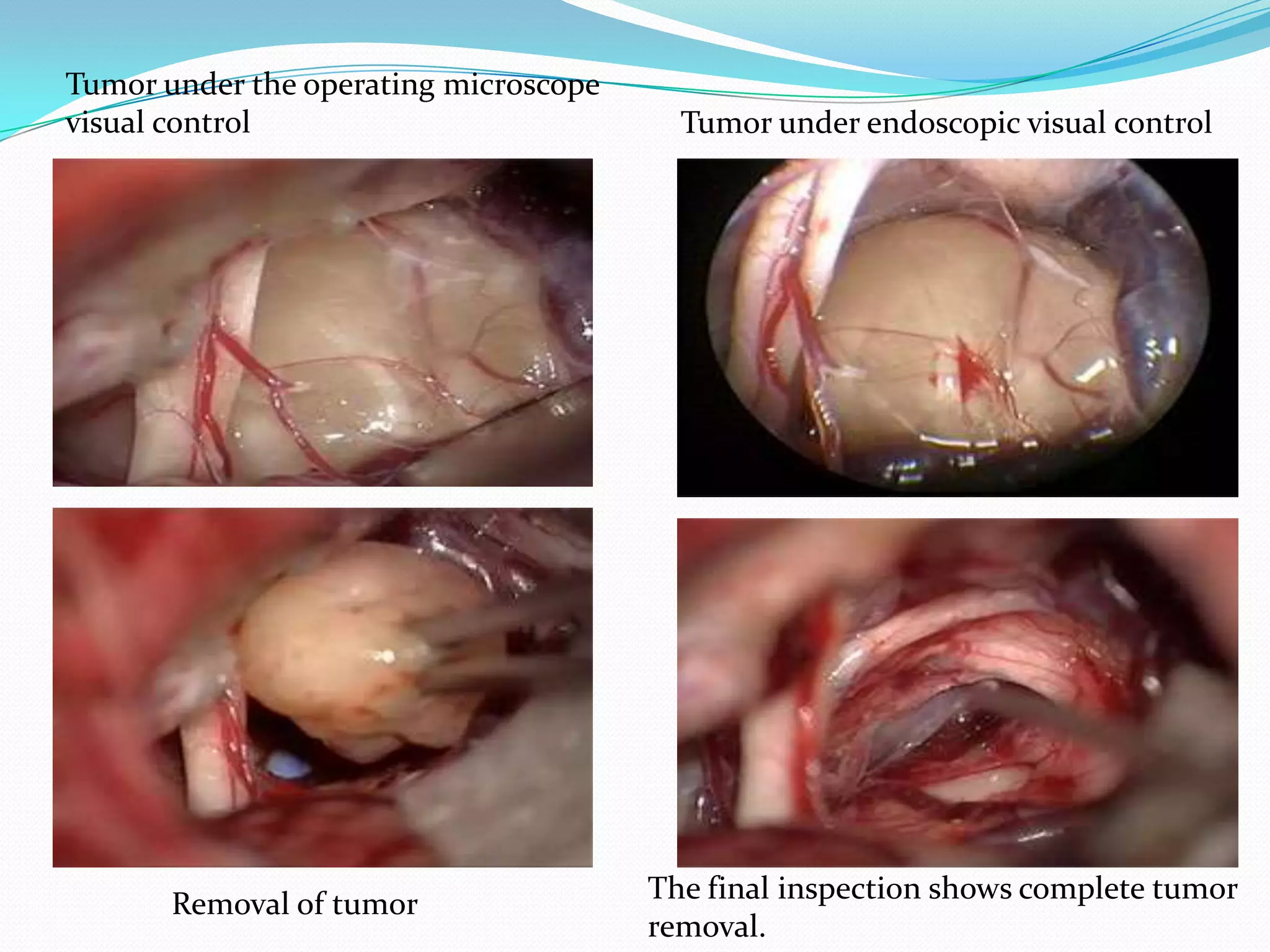 The final inspection shows complete tumor
removal.
Removal of tumor
Tumor under endoscopic visual control
Tumor under the operating microscope
visual control
 
