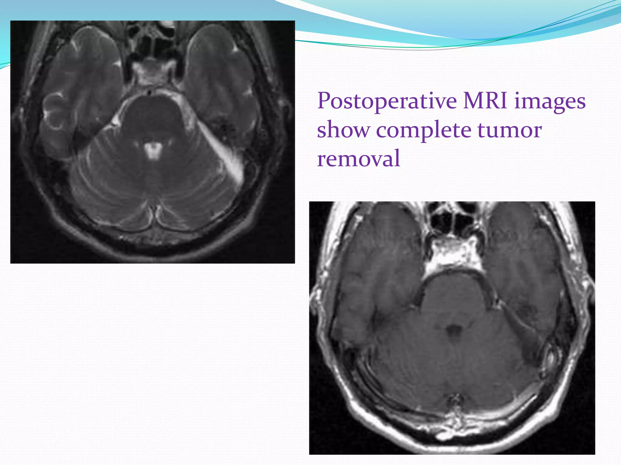 Postoperative MRI images
show complete tumor
removal
 