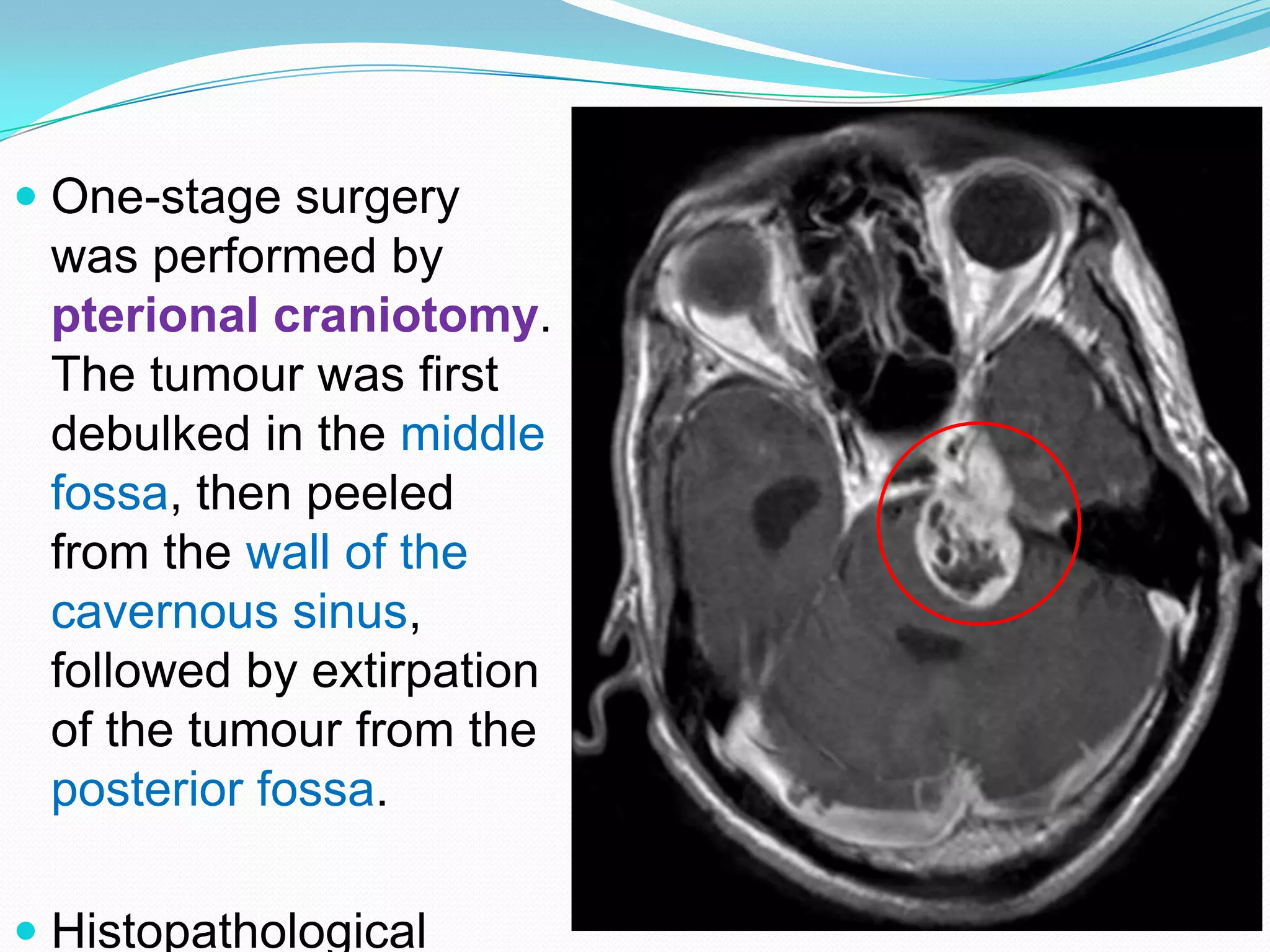  One-stage surgery
was performed by
pterional craniotomy.
The tumour was first
debulked in the middle
fossa, then peeled
from the wall of the
cavernous sinus,
followed by extirpation
of the tumour from the
posterior fossa.
 Histopathological
 