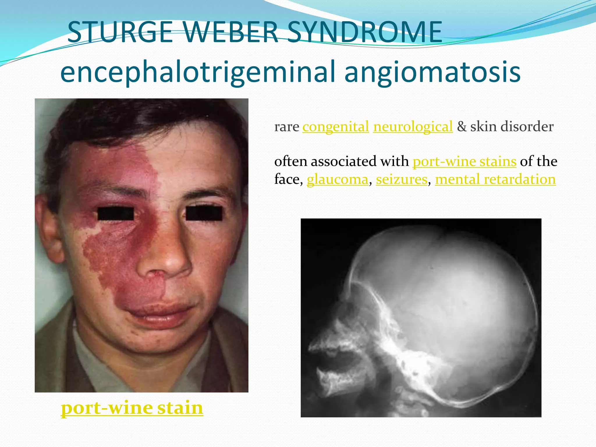 STURGE WEBER SYNDROME
encephalotrigeminal angiomatosis
port-wine stain
rare congenital neurological & skin disorder
often associated with port-wine stains of the
face, glaucoma, seizures, mental retardation
 