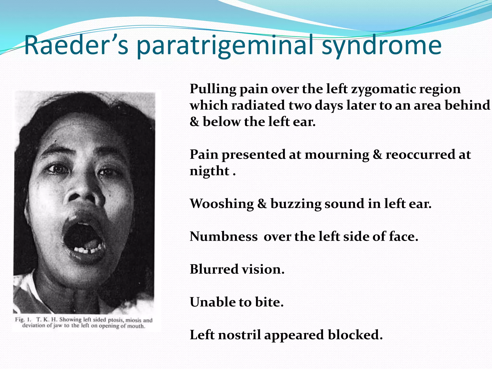 Raeder’s paratrigeminal syndrome
Pulling pain over the left zygomatic region
which radiated two days later to an area behind
& below the left ear.
Pain presented at mourning & reoccurred at
nigtht .
Wooshing & buzzing sound in left ear.
Numbness over the left side of face.
Blurred vision.
Unable to bite.
Left nostril appeared blocked.
 