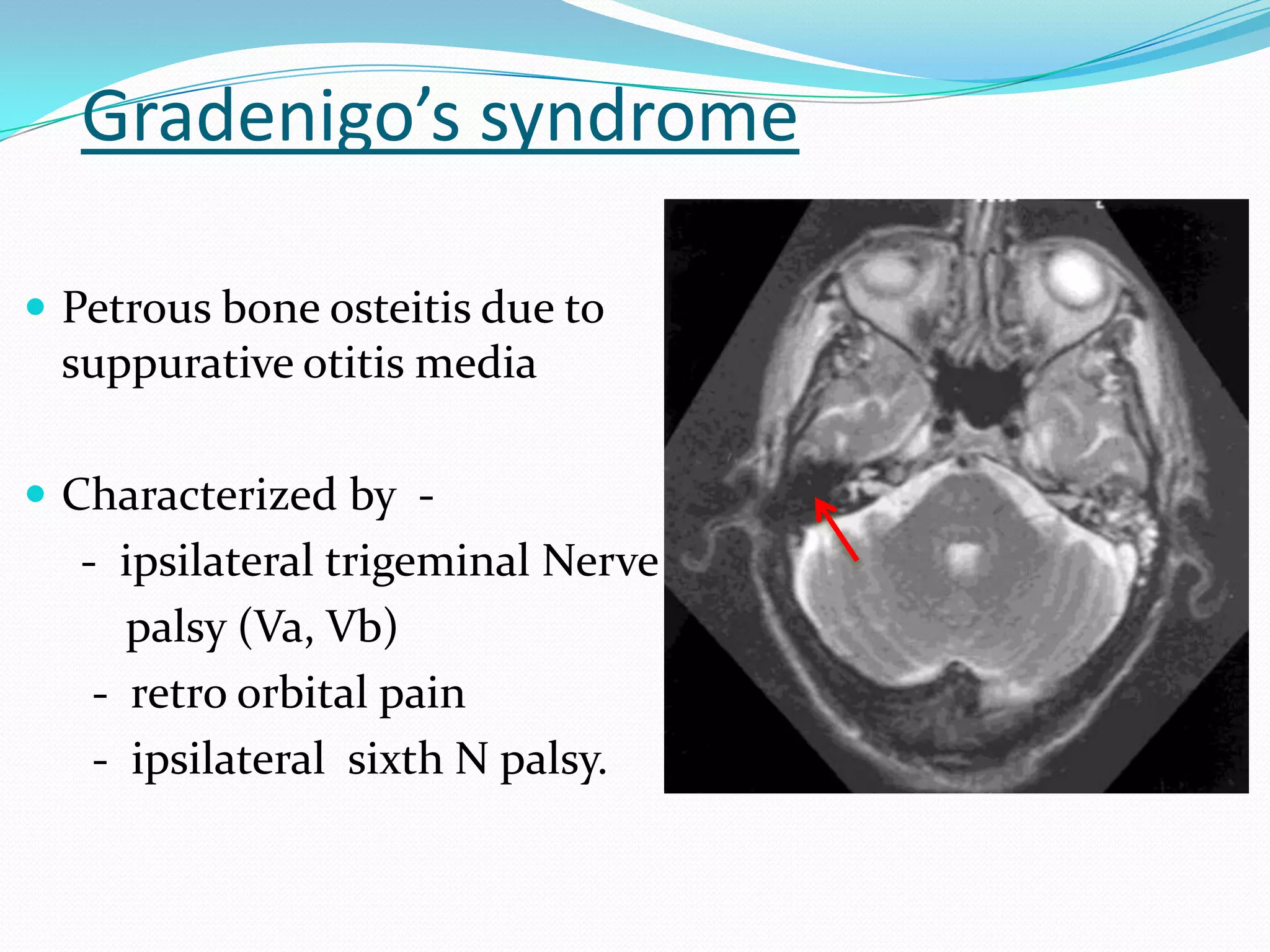 Gradenigo’s syndrome
 Petrous bone osteitis due to
suppurative otitis media
 Characterized by -
- ipsilateral trigeminal Nerve
palsy (Va, Vb)
- retro orbital pain
- ipsilateral sixth N palsy.
 