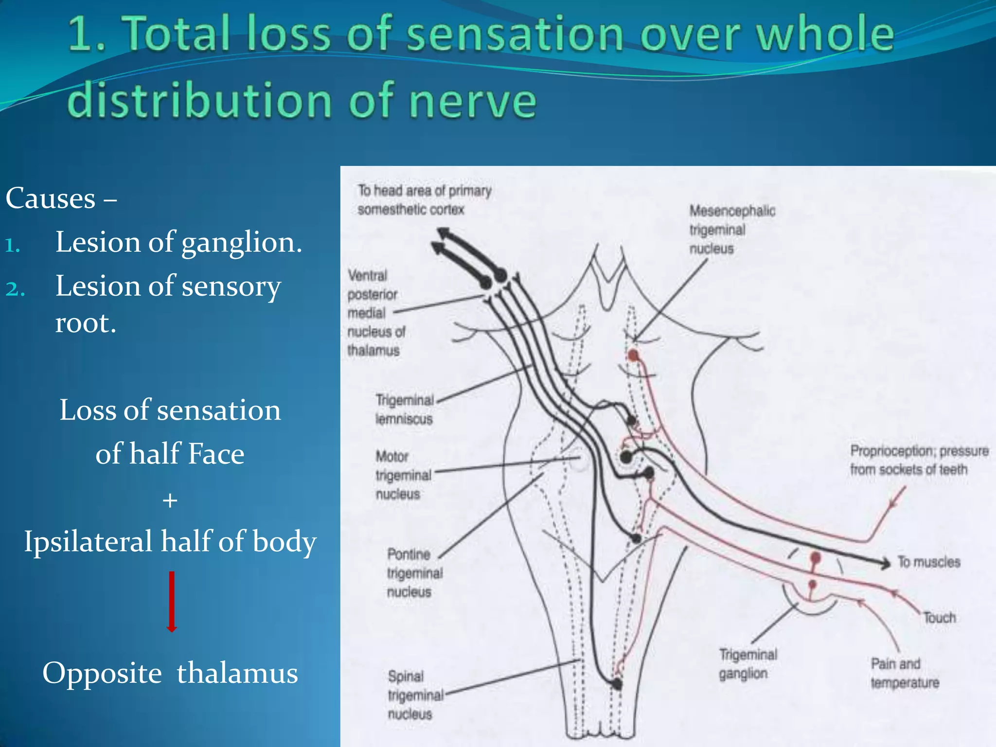 Causes –
1. Lesion of ganglion.
2. Lesion of sensory
root.
Loss of sensation
of half Face
+
Ipsilateral half of body
Opposite thalamus
 