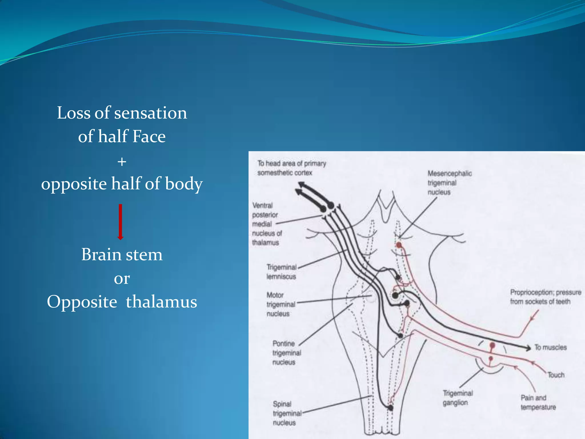 Loss of sensation
of half Face
+
opposite half of body
Brain stem
or
Opposite thalamus
 