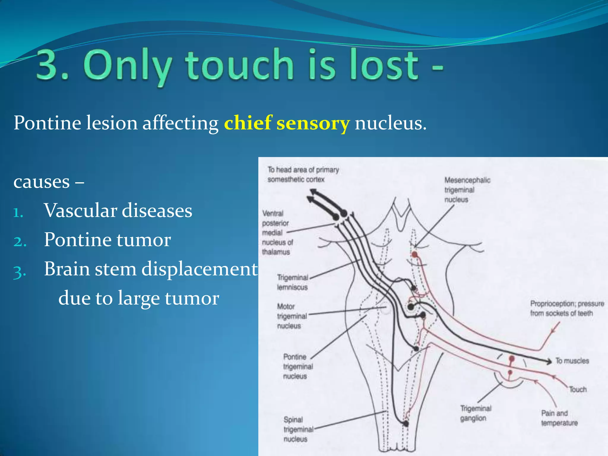 Pontine lesion affecting chief sensory nucleus.
causes –
1. Vascular diseases
2. Pontine tumor
3. Brain stem displacement d
due to large tumor
 