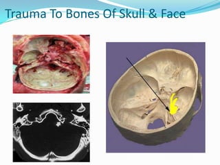 Trauma To Bones Of Skull & Face
 