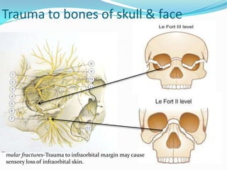 Trauma to bones of skull & face
malar fractures-Trauma to infraorbital margin may cause
sensory loss of infraorbital skin.
 