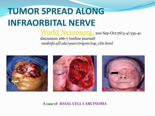 TUMOR SPREAD ALONG
INFRAORBITAL NERVE
World Neurosurg. 2011 Sep-Oct;76(3-4):335-41;
discussion 266-7 (online journal)
medinfo.ufl.edu/year1/trigem/top_clin.html
A case of BASAL CELL CARCINOMA
 