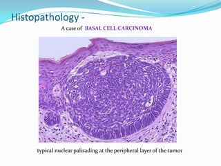 Histopathology -
A case of BASAL CELL CARCINOMA
typical nuclear palisading at the peripheral layer of the tumor
 