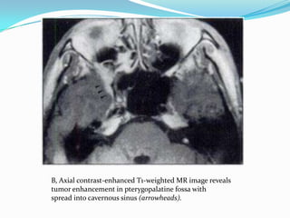 B, Axial contrast-enhanced T1-weighted MR image reveals
tumor enhancement in pterygopalatine fossa with
spread into cavernous sinus (arrowheads).
 