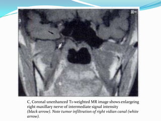 C, Coronal unenhanced T1-weighted MR image shows enlargeing
right maxillary nerve of intermediate signal intensity
(black arrow). Note tumor infiltration of right vidian canal (white
arrow).
 