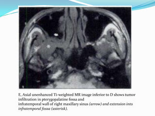 E, Axial unenhanced Ti-weighted MR image inferior to D shows tumor
infiltration in pterygopalatine fossa and
infratemporal wall of right maxillary sinus (arrow) and extension into
infratemporal fossa (asterisk).
 