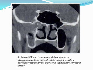 G, Coronal CT scan (bone window) shows tumor in
pterygopalatine fossa (asterisk). Note enlarged maxillary
nerve groove (thick arrow) and normal left maxillary nerve (thin
arrow).
 