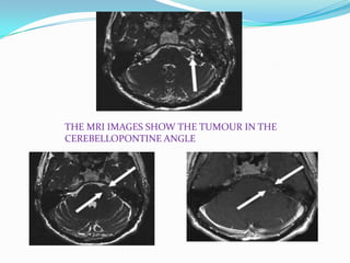 THE MRI IMAGES SHOW THE TUMOUR IN THE
CEREBELLOPONTINE ANGLE
 