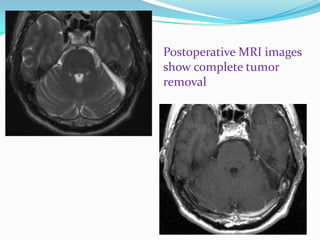 Postoperative MRI images
show complete tumor
removal
 