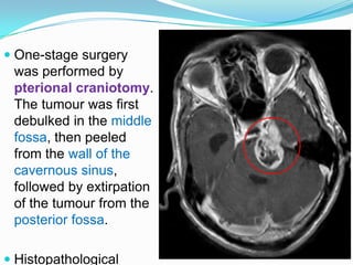  One-stage surgery
was performed by
pterional craniotomy.
The tumour was first
debulked in the middle
fossa, then peeled
from the wall of the
cavernous sinus,
followed by extirpation
of the tumour from the
posterior fossa.
 Histopathological
 