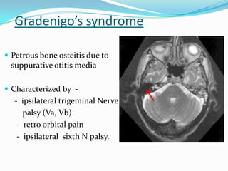 Gradenigo’s syndrome
 Petrous bone osteitis due to
suppurative otitis media
 Characterized by -
- ipsilateral trigeminal Nerve
palsy (Va, Vb)
- retro orbital pain
- ipsilateral sixth N palsy.
 