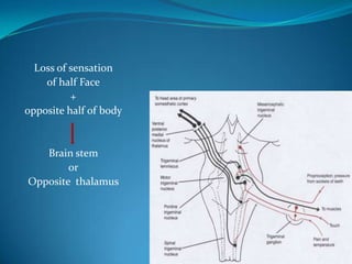 Loss of sensation
of half Face
+
opposite half of body
Brain stem
or
Opposite thalamus
 