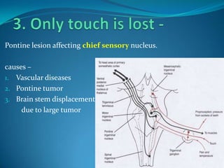 Pontine lesion affecting chief sensory nucleus.
causes –
1. Vascular diseases
2. Pontine tumor
3. Brain stem displacement d
due to large tumor
 